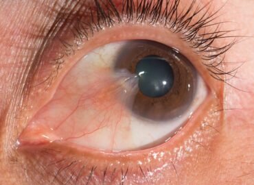 pterygium-in-eye