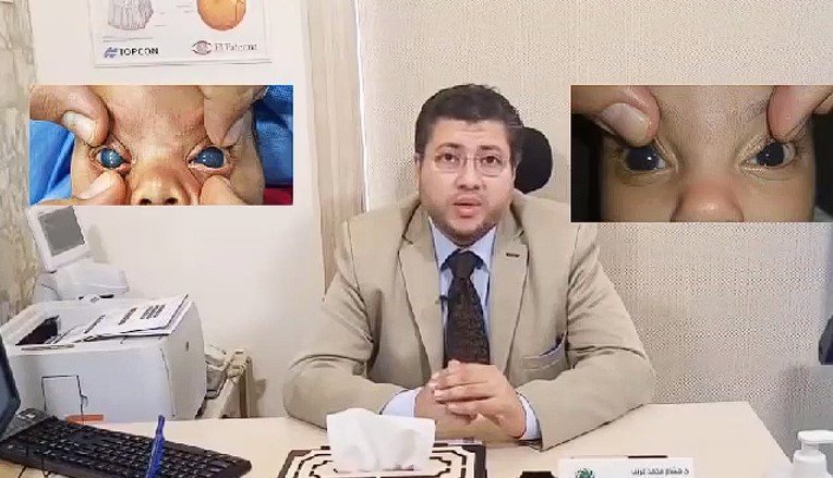 دكتور قرنية مخروطية في مصر