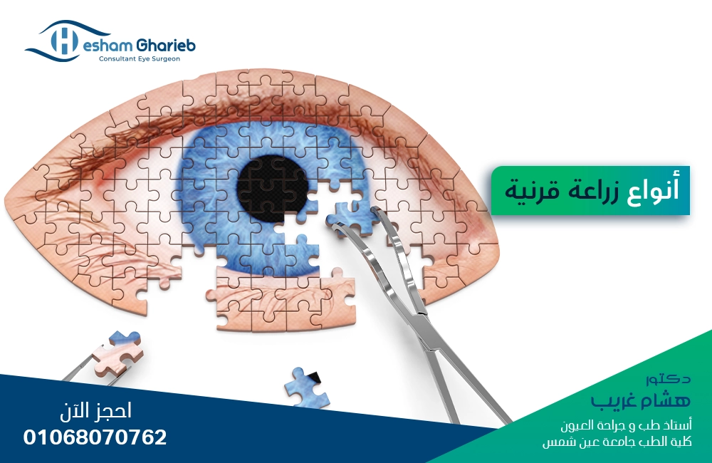 أنواع زراعة قرنية