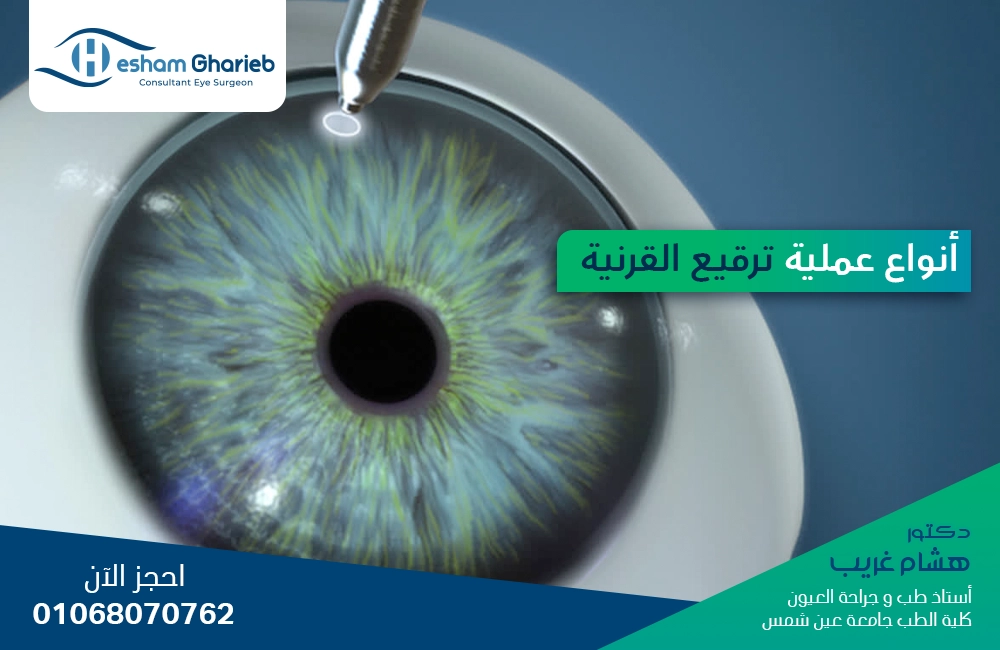 أنواع عملية ترقيع القرنية