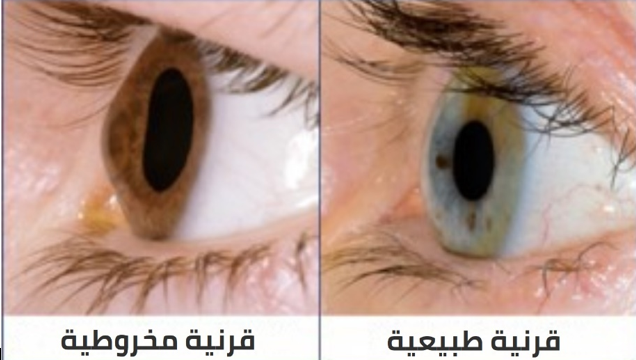 ما هي القرنية المخروطية؟