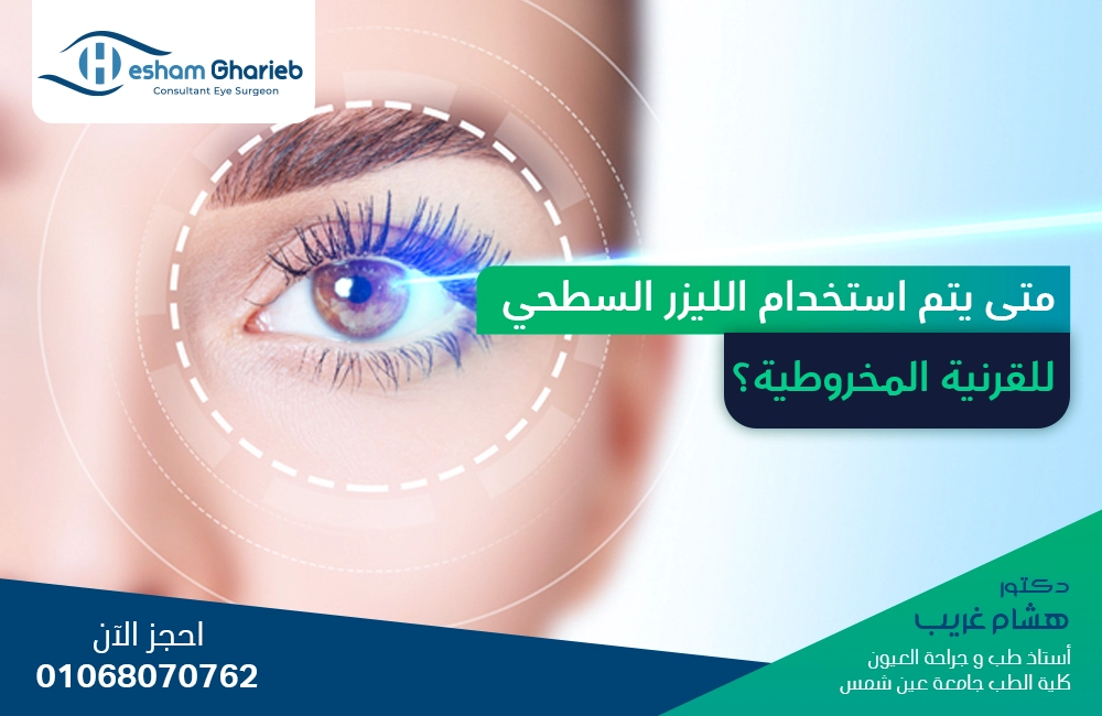 متى يتم استخدام الليزر السطحي للقرنية المخروطية؟