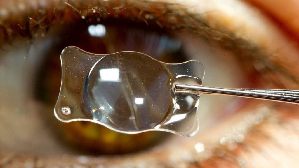 Intraocular Lens Implants