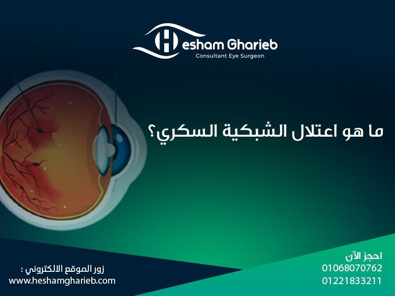 ما هو اعتلال الشبكية السكري